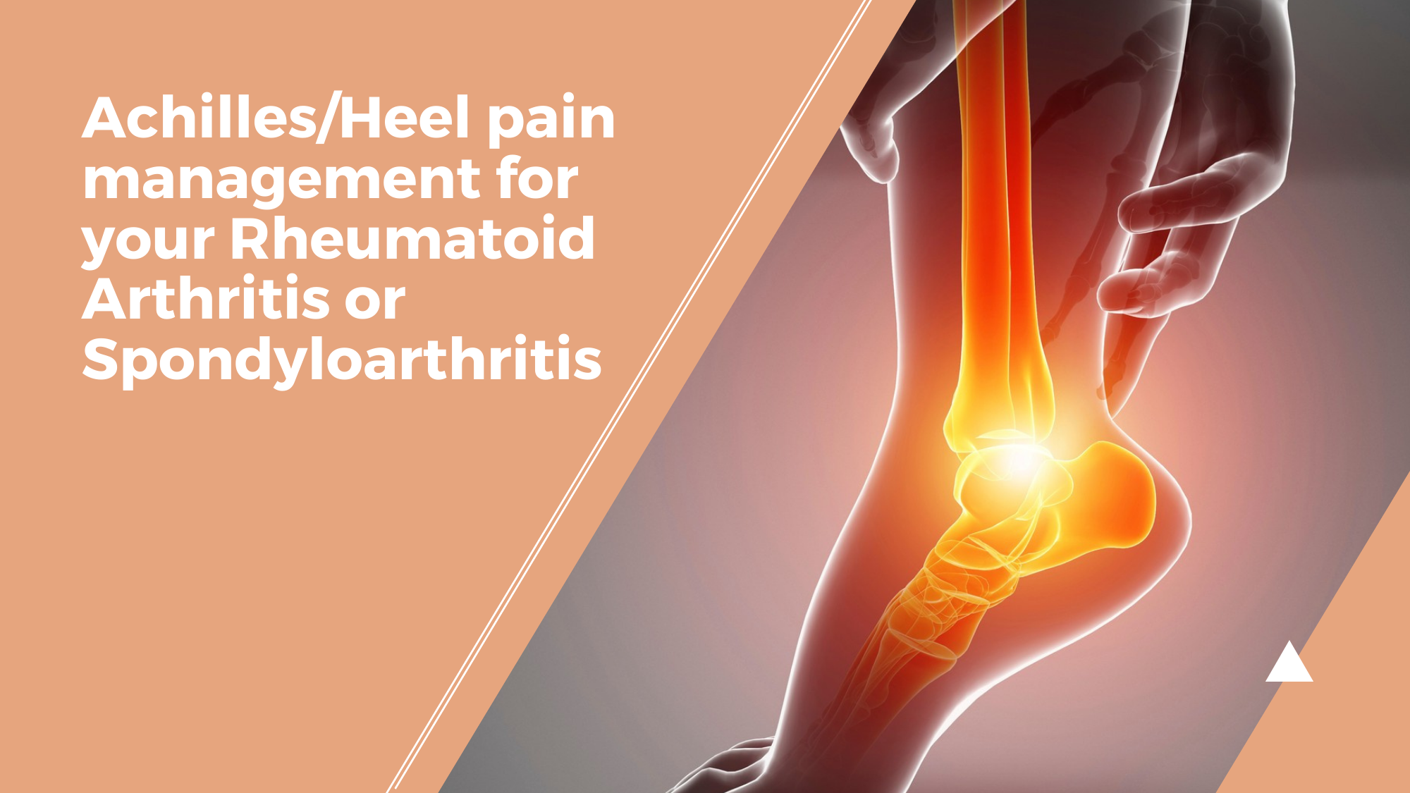 Achilles/Heel pain management for your Rheumatoid Arthritis or